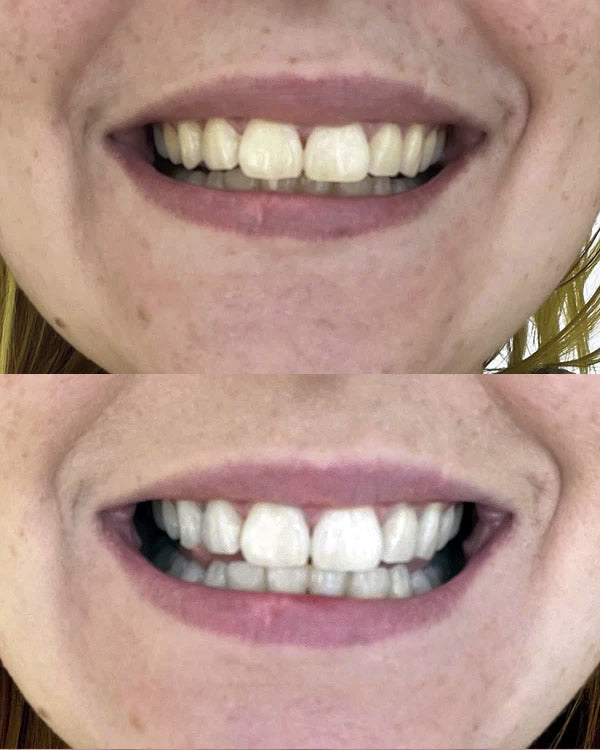 TEETH WHITENING KIT